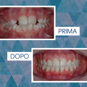 Intercettiva +Ortodonzia fissa (fase 1) 1 anno - Standby - (fase 2) 1 anno